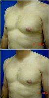 32 Year Old Male Treated For Bilateral Gynecomastia By Doctor Andrew Turk, MD, Naples Plastic Surgeon