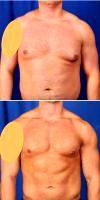 32 Year Old Man Treated With Gynecomastia By Doctor Peter D. Geldner, MD, Chicago Plastic Surgeon