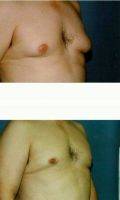 32 Year Old Man Treated With Male Breast Reduction By Doctor James H. Scheu, MD, FACS, Saint Louis Plastic Surgeon
