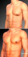 32 Year Old Man Treated With Male Breast Reduction By Dr Steven Teitelbaum, MD, Los Angeles Plastic Surgeon