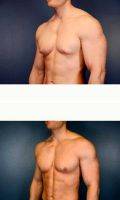 32 Year Old Man Treated With Male Breast Reduction By Dr Terence Michael Myckatyn, MD, Saint Louis Plastic Surgeon