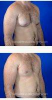 32 Year Old Man Treated With Male Breast Reduction By Dr. Tal T. Roudner, MD, FACS, Miami Plastic Surgeon
