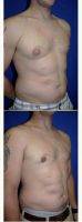 32 Year Old Man Treated With Male Breast Reduction With Doctor Carlos Mata, MD, MBA, FACS, Scottsdale Plastic Surgeon
