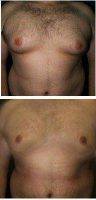 32 Year Old Man Treated With Male Breast Reduction With Dr Marvin F. Shienbaum, MD, Brandon Plastic Surgeon