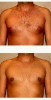 32 Year Old Man Treated With Male Breast Reduction With Dr. Babak Dadvand, MD, Los Angeles Plastic Surgeon