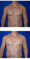 32 Year Old Woman Treated With Male Breast Reduction By Dr. Tal T. Roudner, MD, FACS, Miami Plastic Surgeon