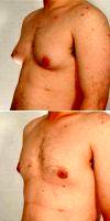 33 Year Old Man Treated With Male Breast Reduction By Doctor Paul J. LoVerme, MD, Montclair Plastic Surgeon