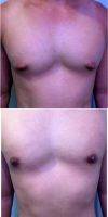 33 Year Old Man Treated With Male Breast Reduction By Doctor S. Larry Schlesinger, MD, FACS, Honolulu Plastic Surgeon