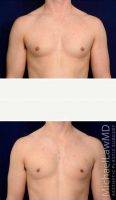 33 Year Old Man Treated With Male Breast Reduction By Dr Michael Law, MD, Raleigh-Durham Plastic Surgeon