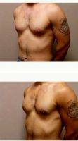 33 Year Old Man Treated With Male Breast Reduction By Dr Shahriar Mabourakh, MD, FACS, Sacramento Plastic Surgeon