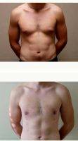 33 Year Old Man Treated With Male Breast Reduction With Dr. Shahriar Mabourakh, MD, FACS, Sacramento Plastic Surgeon