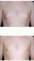 33 Year Old Man Treated With Male Breast Reduction With Dr. Steven L. Robinson, MD, Columbus Plastic Surgeon