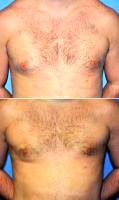 34 Year Old Man Treated With Male Breast Reduction By Doctor Robert D. Wilcox, MD, Dallas Plastic Surgeon