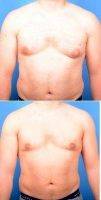 34 Year Old Man Treated With Male Breast Reduction By Doctor Sanjiv Kayastha, MD, Albany Plastic Surgeon