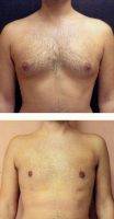 34 Year Old Man Treated With Male Breast Reduction By Dr Fara Movagharnia, DO, FACOS, Atlanta Plastic Surgeon