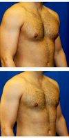 34 Year Old Man Treated With Male Breast Reduction (Photo Set 2) By Dr. John Nguyen, MD, FACS, Houston Plastic Surgeon