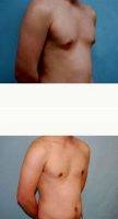 34 Year Old Man Treated With Male Breast Reduction With Doctor Tad Grenga, MD, FACS, Suffolk Plastic Surgeon