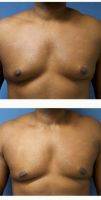 35-44 Year Old Man Treated With Male Breast Reduction By Dr Carlos Burnett, MD, FACS, Westfield Plastic Surgeon