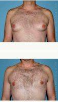 35-44 Year Old Man Treated With Male Breast Reduction By Dr Jose Perez-Gurri, MD, FACS, Miami Plastic Surgeon