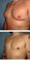 35-44 Year Old Man Treated With Male Breast Reduction By Dr Sean T. Lille, MD, Scottsdale Plastic Surgeon