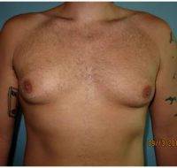 35-44 Year Old Man Treated With Male Breast Reduction By Dr Sean T. Lille, MD, Scottsdale Plastic Surgeon