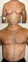 35-44 Year Old Man Treated With Male Breast Reduction By Dr. Arthur G. Handal, MD, FACS, Boca Raton Plastic Surgeon