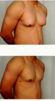 35-44 Year Old Man Treated With Male Breast Reduction By Dr. R. Scott Yarish, MD, Houston Plastic Surgeon