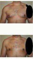 35-44 Year Old Man Treated With Male Breast Reduction By Dr. Tim Neavin, MD, Beverly Hills Plastic Surgeon