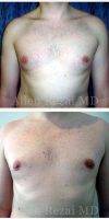 35-44 Year Old Man Treated With Male Breast Reduction With Dr Allen Rezai, MD, London Plastic Surgeon