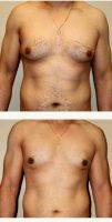 35-44 Year Old Man Treated With Male Breast Reduction With Dr Bryan C. McIntosh, MD, Bellevue Plastic Surgeon