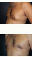 35-44 Year Old Man Treated With Male Breast Reduction With Dr Semira Bayati, MD, FACS, Orange County Plastic Surgeon