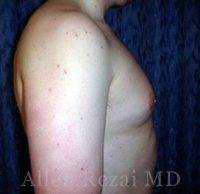 35-44 Year Old Man Treated With Male Surgery With Dr Allen Rezai, MD, London Plastic Surgeon