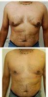 35 Year Old Man Treated With Male Breast Reduction By Doctor Bryson G. Richards, MD, Las Vegas Plastic Surgeon
