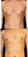 35 Year Old Man Treated With Male Breast Reduction By Doctor David S. Rosenberg, MD, Beverly Hills Plastic Surgeon