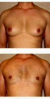 35 Year Old Man Treated With Male Breast Reduction By Dr. Babak Dadvand, MD, Los Angeles Plastic Surgeon