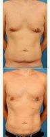 35 Year Old Man Treated With Male Breast Reduction - Liposuction To Flanks, Abdomen And Upper Back With Dr Brian Coan, MD, FACS, Raleigh-Durham Plastic Surgeon