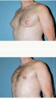 35 Year Old Man Treated With Male Breast Reduction With Doctor Jose Perez-Gurri, MD, FACS, Miami Plastic Surgeon