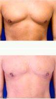 35 Year Old Man Treated With Male Breast Reduction With Dr Zoran Potparic, MD, Fort Lauderdale Plastic Surgeon