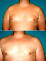 36 Year Old Male Gynecomastia Patient With Dr Paul M. Gardner, MD, FACS, Naples Plastic Surgeon