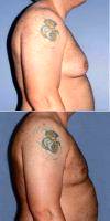 36 Year Old Man Treated With Male Breast Reduction By Doctor Rikesh T. Parikh, MD, Bellevue Plastic Surgeon