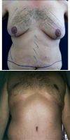 36 Year Old Man Treated With Male Breast Reduction By Dr Carolina Restrepo, MD, Colombia Plastic Surgeon