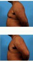36 Year Old Man Treated With Male Breast Reduction With Doctor Brian Coan, MD, FACS, Raleigh-Durham Plastic Surgeon