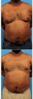 36 Year Old Man Treated With Male Breast Reduction With Doctor Brian Coan, MD, FACS, Raleigh-Durham Plastic Surgeon