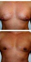 36 Year Old Man Treated With Male Breast Reduction With Doctor John Michael Thomassen, MD, Fort Lauderdale Plastic Surgeon 694
