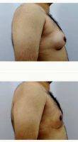 36 Year Old Man Treated With Male Breast Reduction With Doctor Milan Doshi, MS, MCh, India Plastic Surgeon