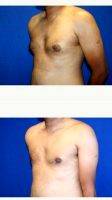 36 Year Old Man With Gynecomastia Treated With Male Breast Reduction By Dr. Daniel Brown, MD, FACS, La Jolla Plastic Surgeon