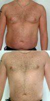37 Year Old Man Treated With Male Breast Reduction With Doctor Paul J. LoVerme, MD, Montclair Plastic Surgeon
