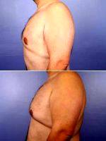 37 Yr Old Male Weight Loss Patient With Doctor Grant Stevens, MD, Los Angeles Plastic Surgeon