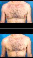 38 Year Old Man Treated For Male Breast Reduction By Doctor Saeed Marefat, MD, Washington DC Plastic Surgeon