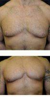 38 Year Old Man Treated With Male Breast Reduction By Dr Christopher J. Davidson, MD, FACS, Boston Plastic Surgeon
